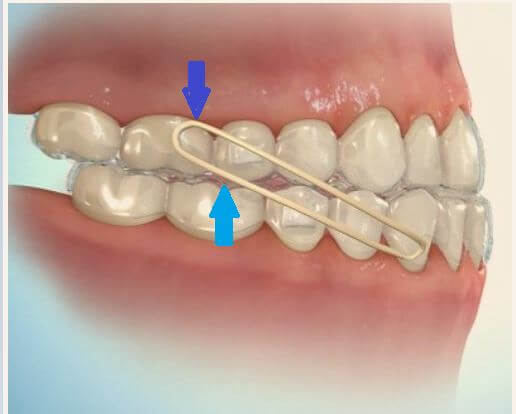 Invisalign