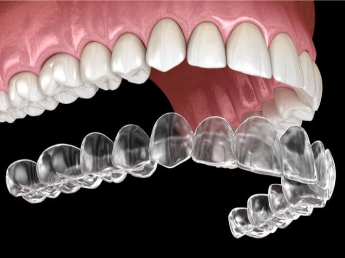 Invisalign